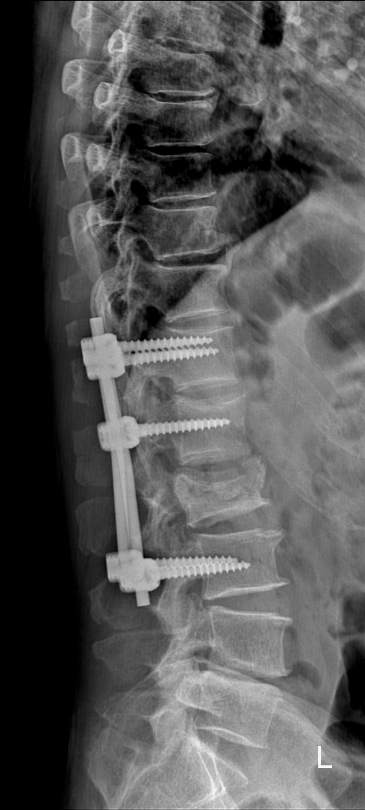 Radiografía de columna con implantes