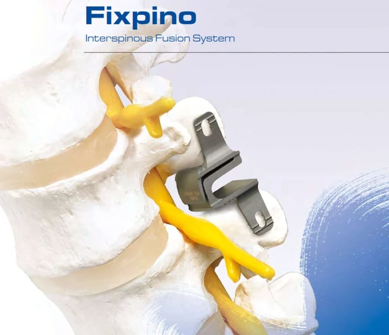 Fixpino Interspinous Fusion System mostrando modelo de vértebras con dispositivos de implantes amarillos y herrajes metálicos